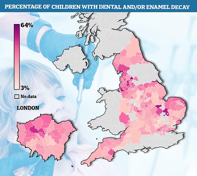 Three in 10 children across the country have enamel or tooth decay, according to data from the Office for Health Improvement and Disparities (OHID). But in Cambridge, the worst-hit part of the country, the figure is 63.6 per cent. However, just 3.4 per cent of youngsters are affected in Cannock Chase, Staffordshire ¿ the lowest rate in the country
